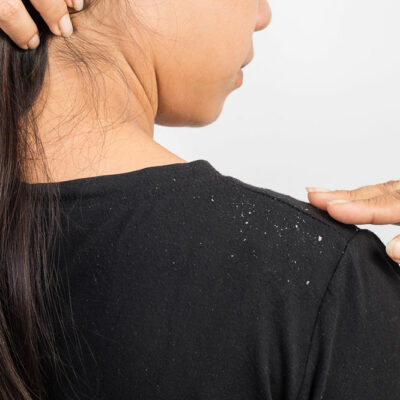 Top Tips That Help Treat Dandruff