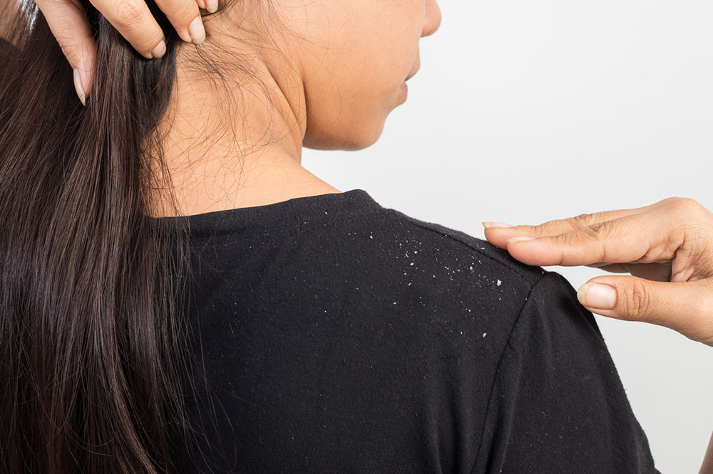 Top Tips That Help Treat Dandruff