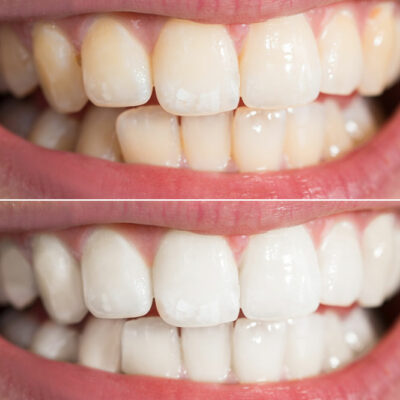 8 Mistakes to Avoid When Whitening  Teeth