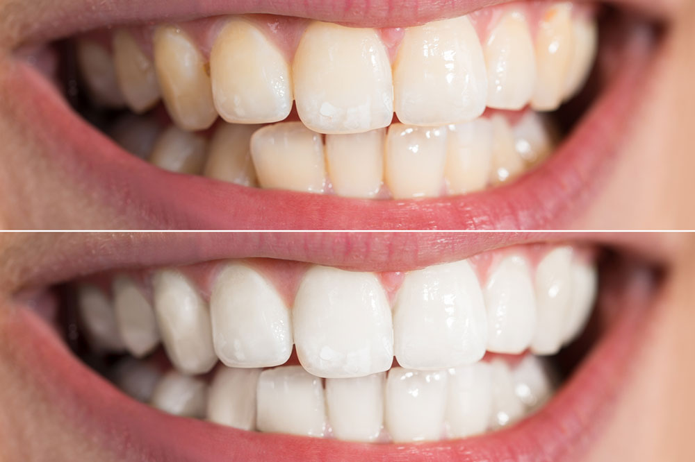 8 Mistakes to Avoid When Whitening  Teeth